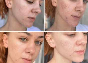 Dermapen Iskrena Recenzija i Iskustva: Je li Vrijedan Tretman za Pomlađivanje Kože?