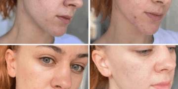 Dermapen Iskrena Recenzija i Iskustva: Je li Vrijedan Tretman za Pomlađivanje Kože? 10 Dermapen Iskrena Recenzija i Iskustva: Je li Vrijedan Tretman za Pomlađivanje Kože?