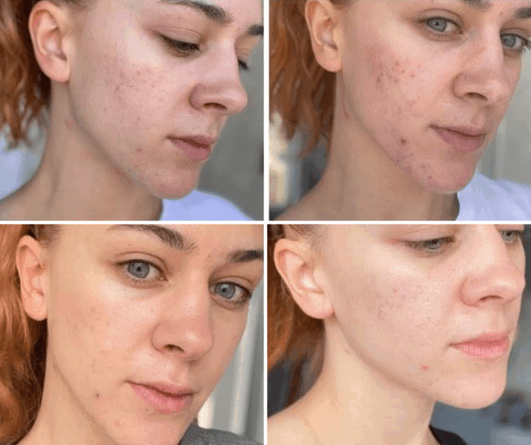 dermapen iskrena recenzija i iskustva je li vrijedan tretman za pomladivanje koze